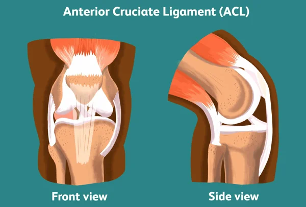 Anterior Cruciate Ligament (ACL) Injury
