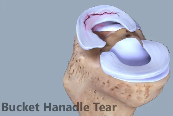Meniscal Injury