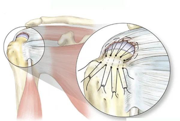Rotator Cuff Injury