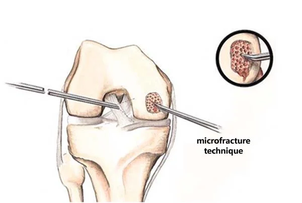 Cartilage Injury