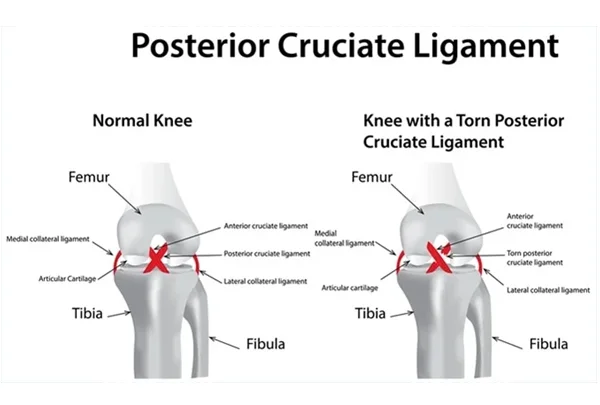 PCL (Posterior Cruciate Ligament) Injury