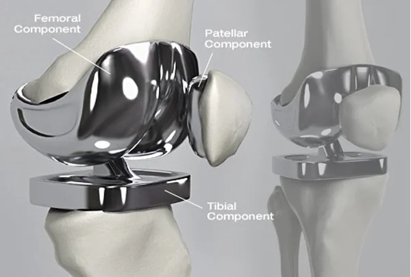 Total Knee Replacement